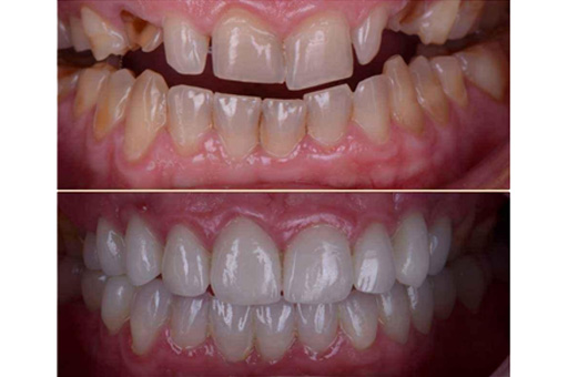 Smile designing Before and After Image